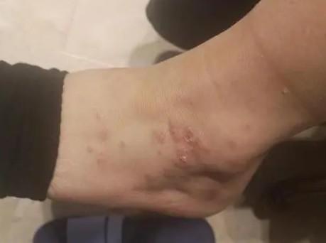 猫毛过敏皮肤症状图片-图1