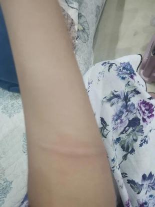 被自己狗咬出血了怎么办